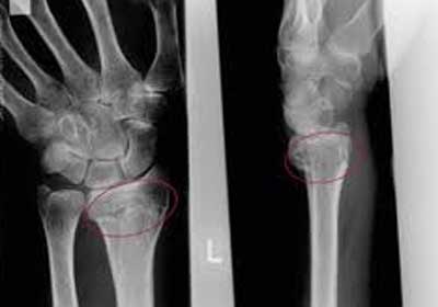 Bone-fractures-11.jpg